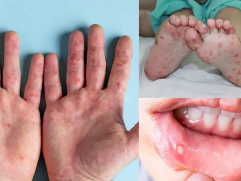 Bệnh tay chân miệng biểu hiện bằng các nốt tổn thương trên da